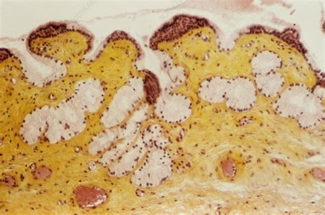 Bartholin S Cyst Light Micrograph Stock Image C015 6409 Science Bartholin S Cyst Light Micrograph Stock Image C015 6409 Science