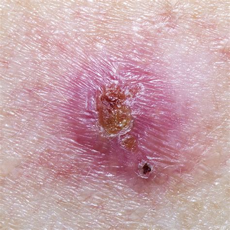 Basal Cell Removal