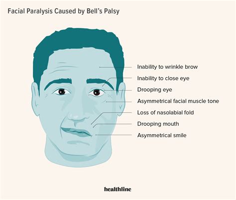 Bell's Palsy Selfcare