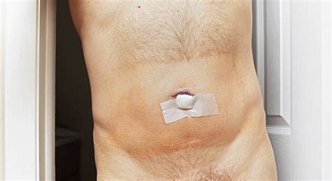 Belly Button Hernia Surgery