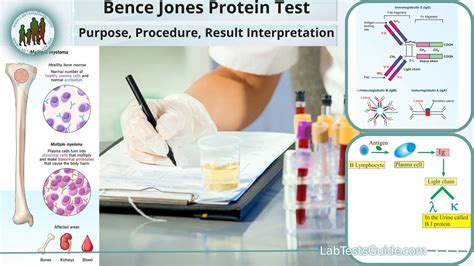 Bence Jones Protein Test Test Purpose Procedure Result Interpretation Bence Jones Protein Test Test Purpose Procedure Result Interpretation