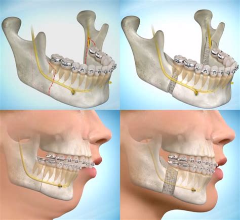 Benefits Of Orthognathic Jaw Surgery In Our Perth Practice