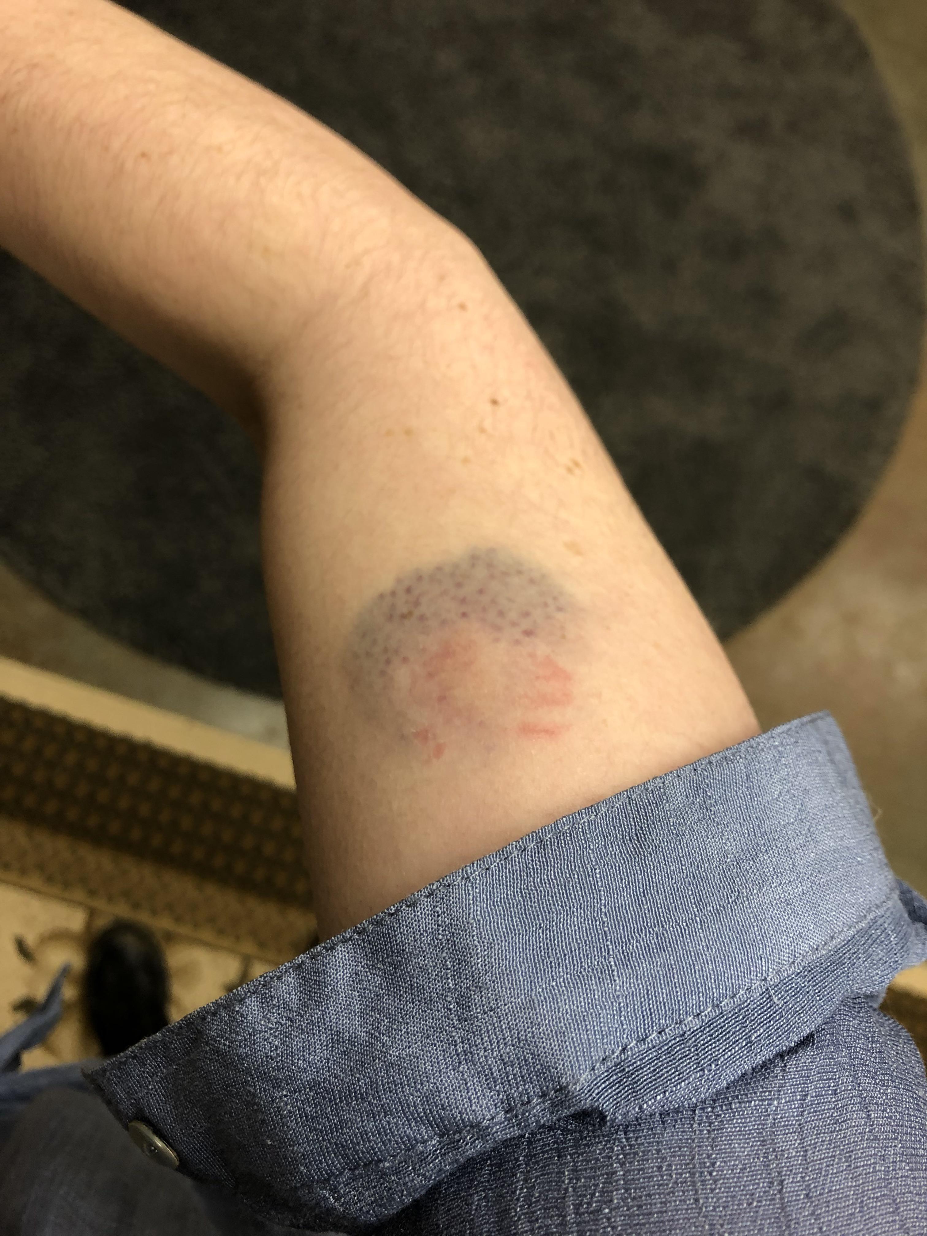 Bite Of Human: Avoid Infection Risks