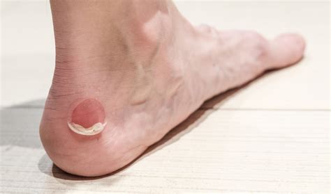 Blister On Foot