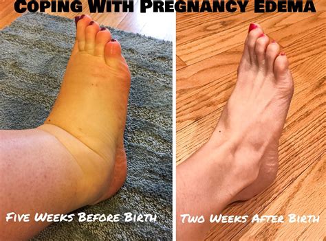 Bloated Feet After Pregnancy