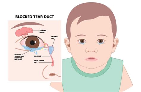 Blocked Tear Duct Baby