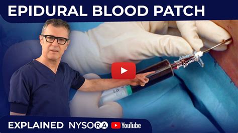 Blood Patch Procedure