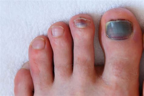 Blood Under A Nail