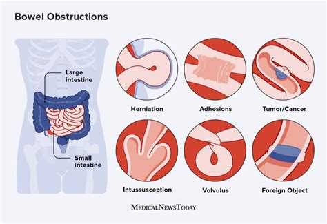 Bowel Obstruction Causes Revealed