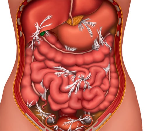 Bowel Obstruction Selfcare
