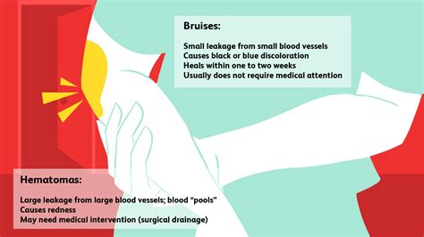 Brilliant Info About How To Prevent A Bruise Securityquarter28