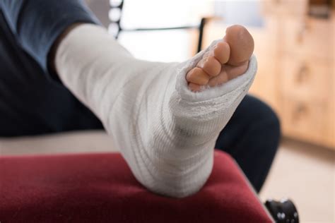 Broken Foot Treatment: Recover In Less Time