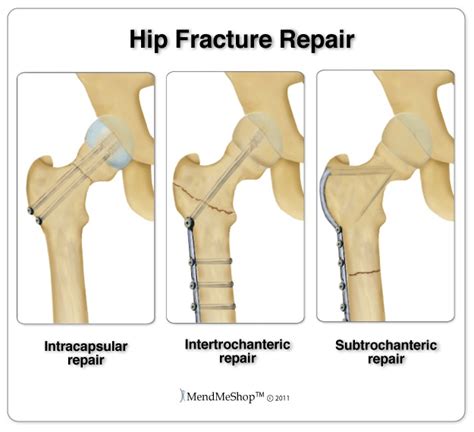 Broken Hip Surgery: Quick Recovery Guide