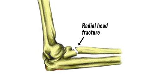 Broken Radial Head