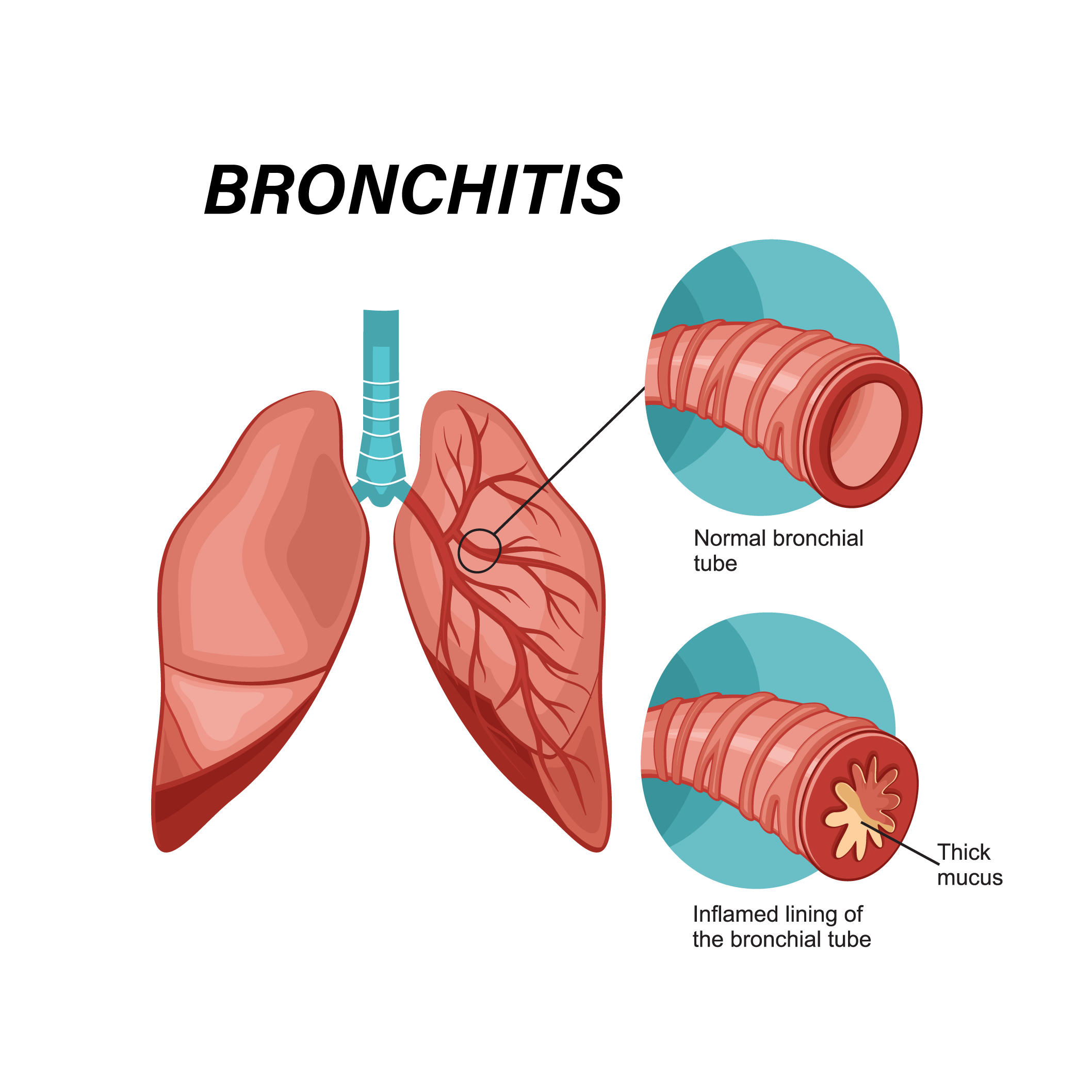 Bronchitis Antibiotics Guide: Know When