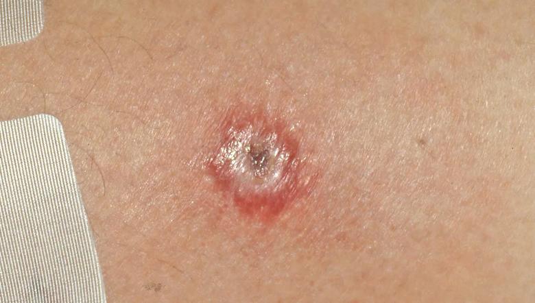 Brown Recluse Spider Bites