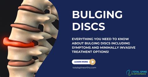 Bulging Disc In Lumbar Region