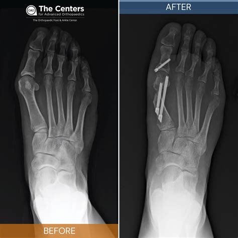 Bunion Surgery Recovery