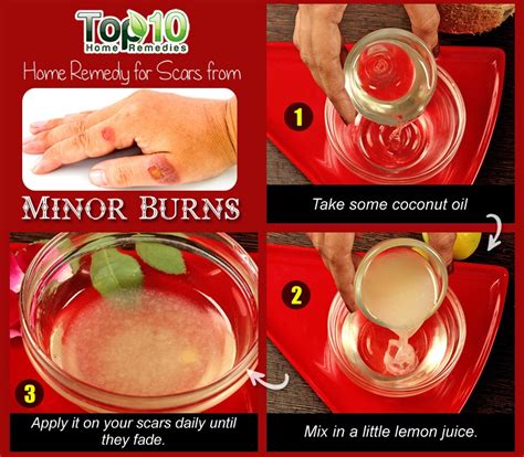 Burn Treatment: Relief With Home Remedies