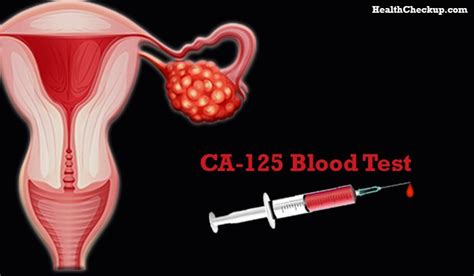 Ca 125 Blood Test
