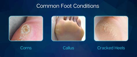 Callus On Foot