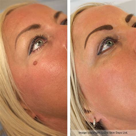 Can You Remove Moles