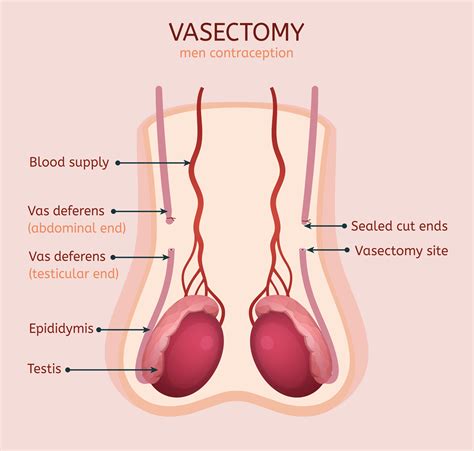 Can You Undo A Vasectomy