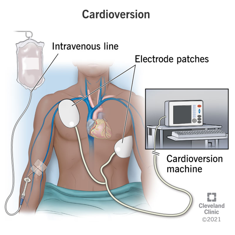 Cardioversion For Afib