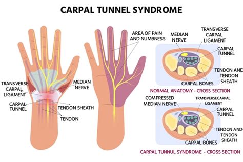 Carpal Tunnel Syndrome Causes Symptoms And Treatment