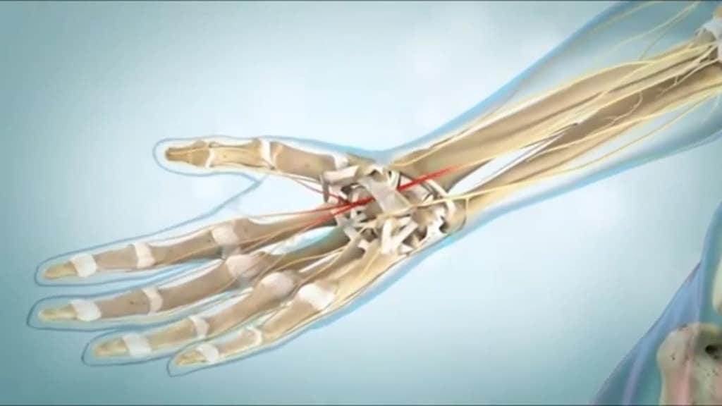 Carpel Tunnel Relief: Surgery Options Explained