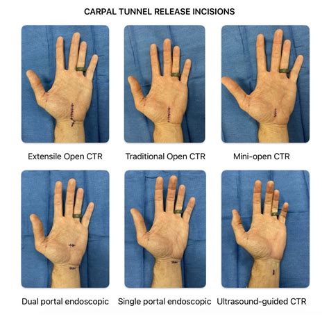 Carpel Tunnel Surgery Guide: Recovery Simplified