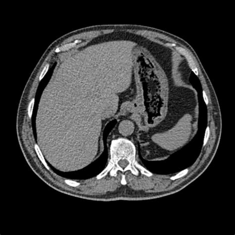 Cat Scan Of Stomach