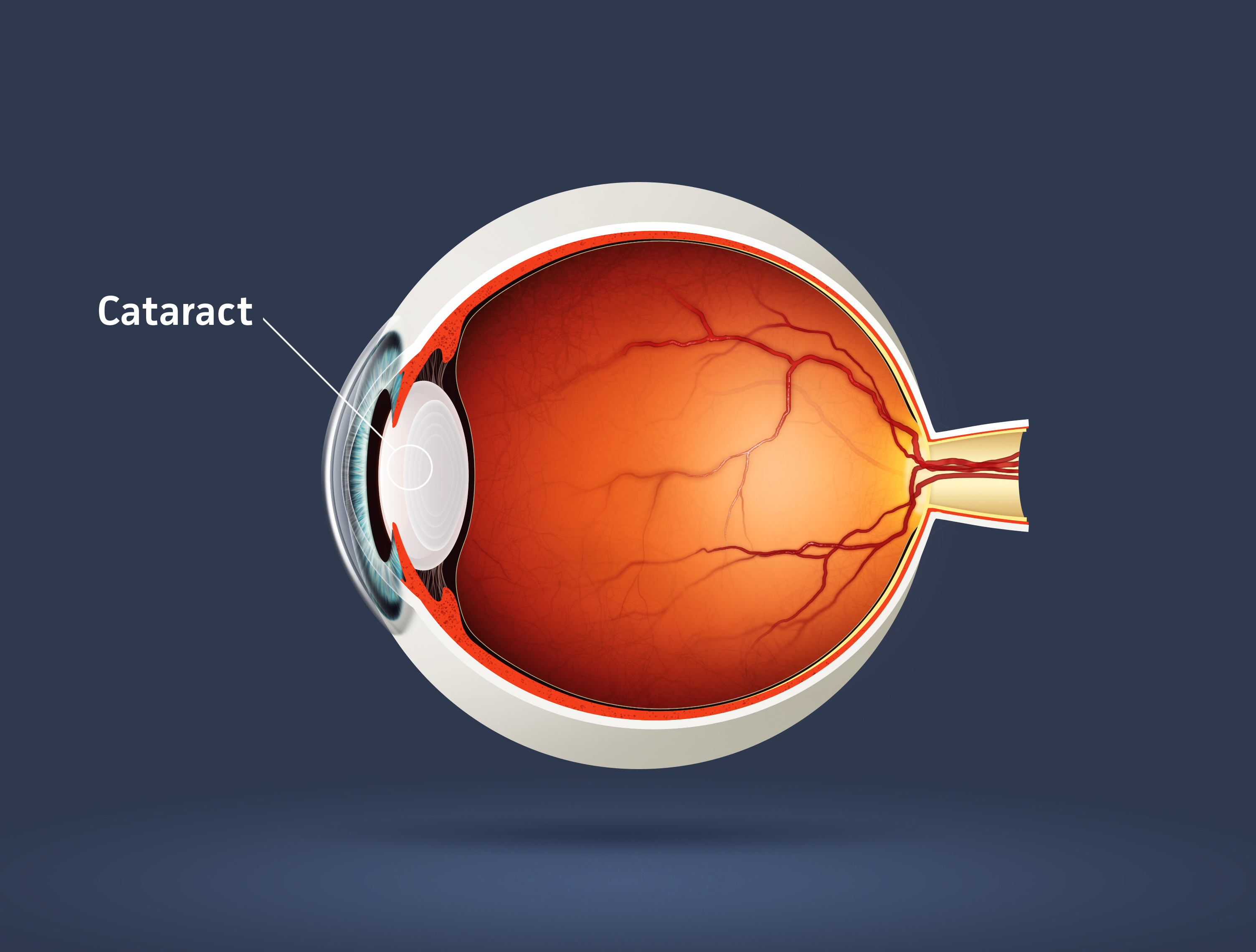 Cataract Procedure Recovery