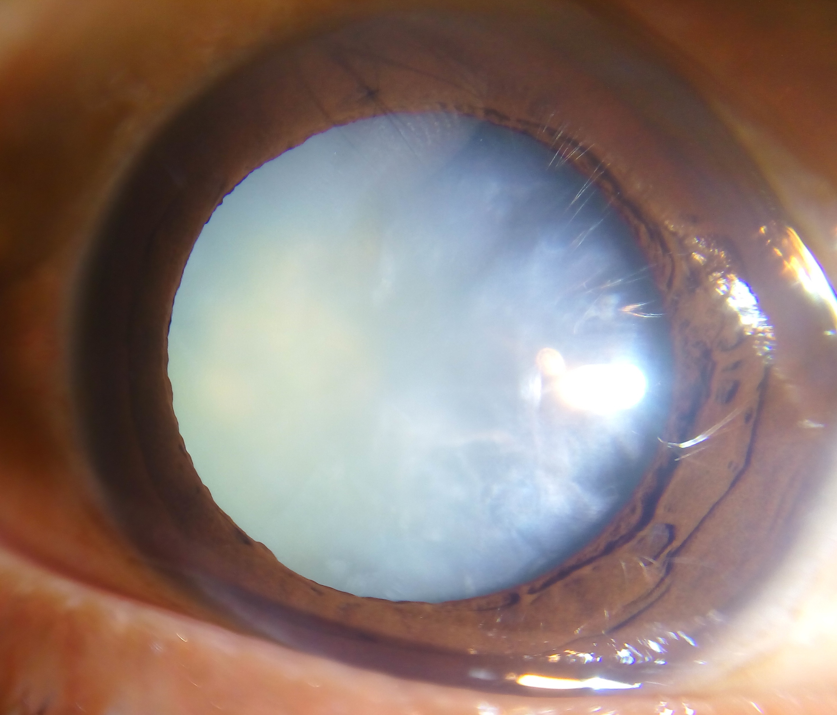 Cataract Surgery Recovery Timeline Dr Jimmy Lim Eye Specialist Cataract Surgery Recovery Timeline Dr Jimmy Lim Eye Specialist