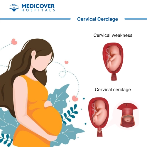Cerclage Of The Cervix