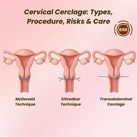 Cervical Cerclage Procedure