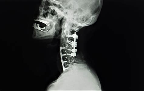 Cervical Fusion Surgery