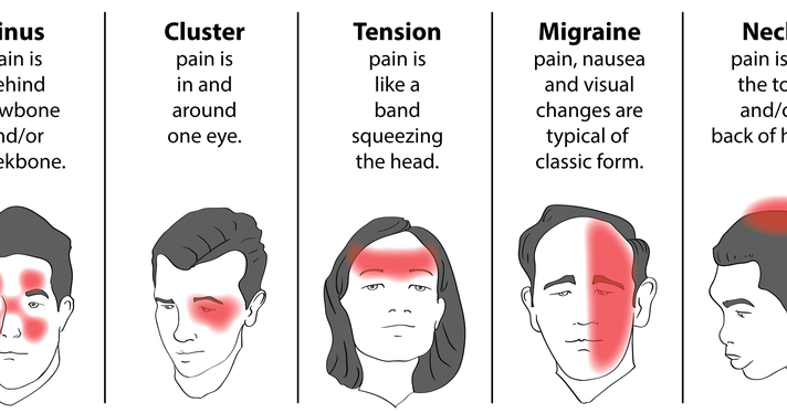 Characteristics Of Tension Headaches