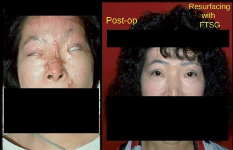 Chemical Burn Facial Contracture Treated With 1 Resurfacing Of Nose Chemical Burn Facial Contracture Treated With 1 Resurfacing Of Nose