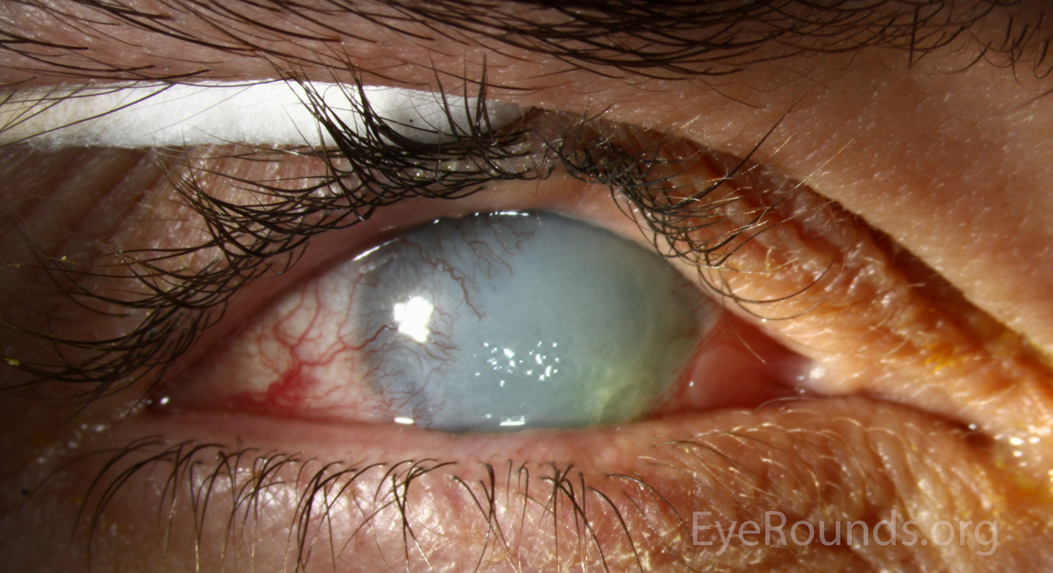 Chemical Burn In Eye