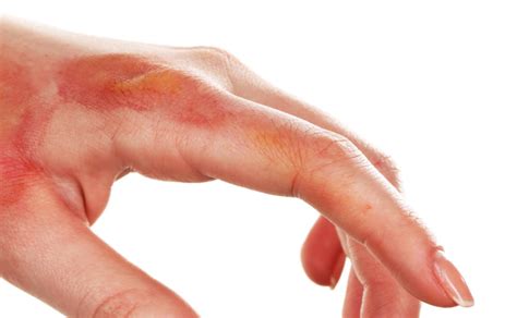 Chemical Burn On Skin