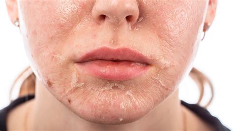 Chemical Burn Skin Care: Fast Relief