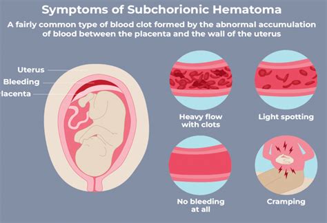 Chorionic Hematoma Bleeding: Causes & Symptoms
