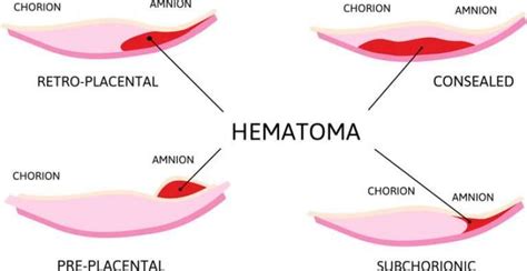 Chorionic Hematoma: Treatment Options & Recovery Guide