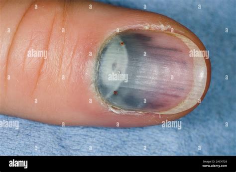 Close Up Of Bruising Under The Fingernail Subungual Haematoma In A 30 Close Up Of Bruising Under The Fingernail Subungual Haematoma In A 30