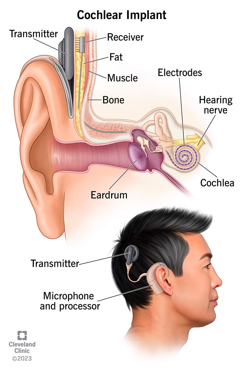 Cochlear Implant Surgery Guide: Success Strategies