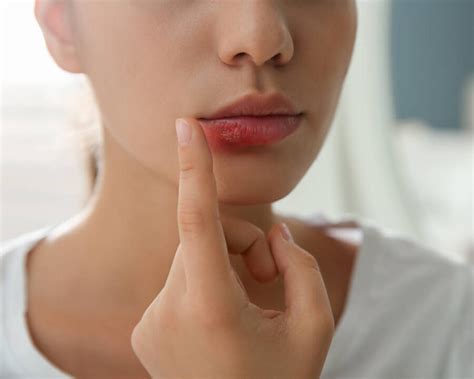 Cold Sore Specialists