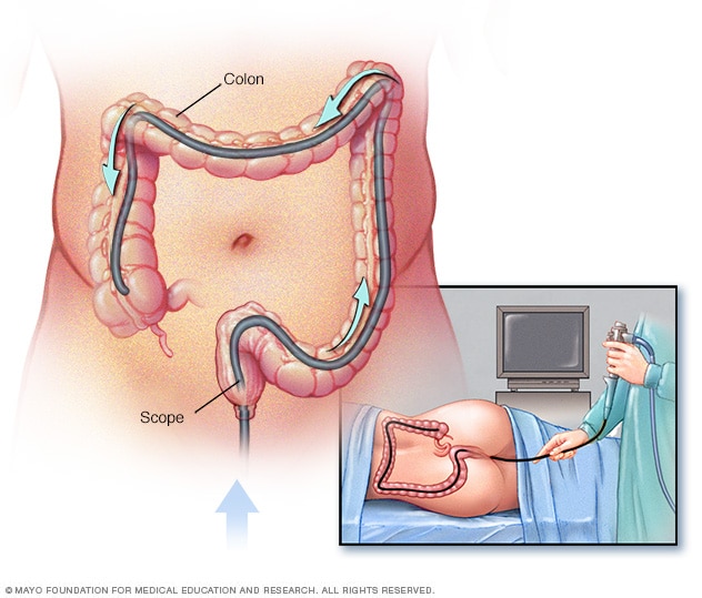 Colonoscopy Diet Guide: Prep Right