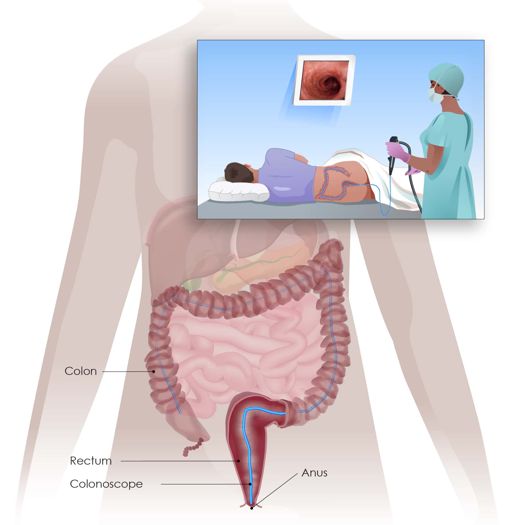 Colonoscopy Prep: Simple Steps For Success