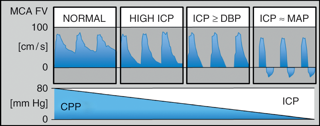 Comparison Of The Clinical Value Of Transcranial Doppler Ultrasound And